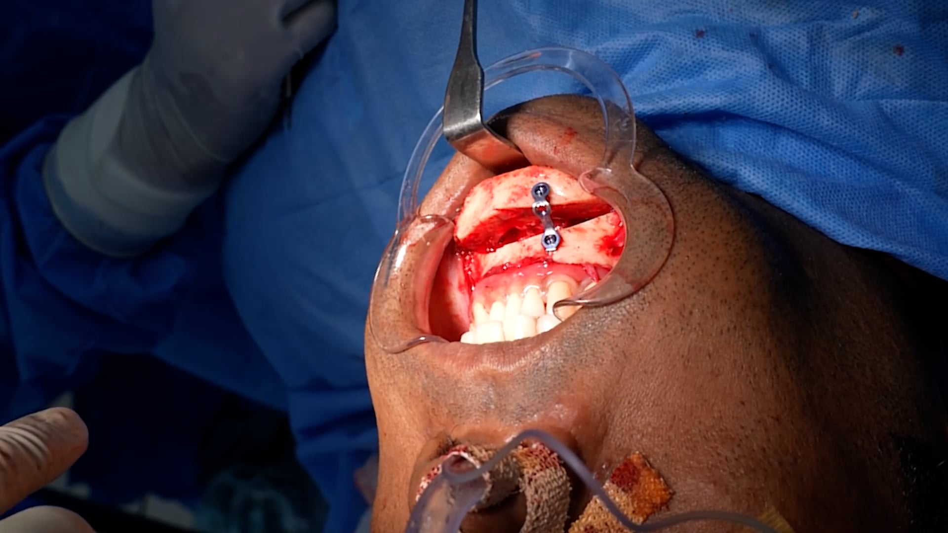 Genioplasty and Jaw sculpting